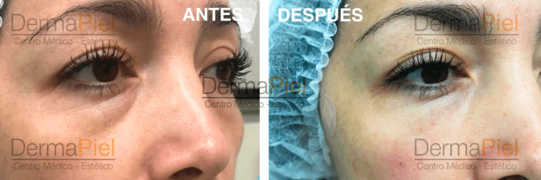 Relleno De Ojeras Hundidas Dermapiel