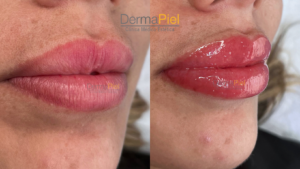 Micropigmentación del labios