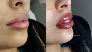 Micropigmentación del labios