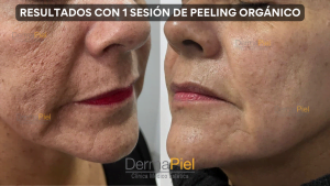 PEELING ORGÁNICO