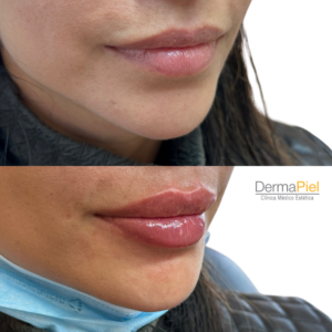 Relleno De Labios