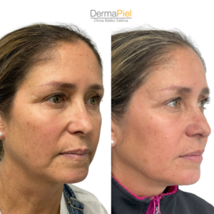 HIFU 7D Facial
