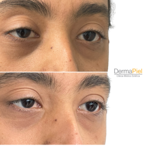 Relleno de Ojeras