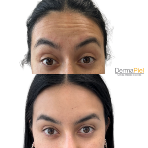 Baby Botox