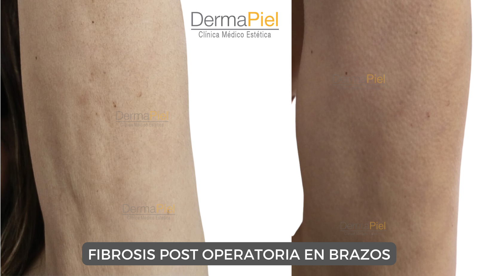 FIBROSIS-POST-OPERATORIA-EN-BRAZOS.png