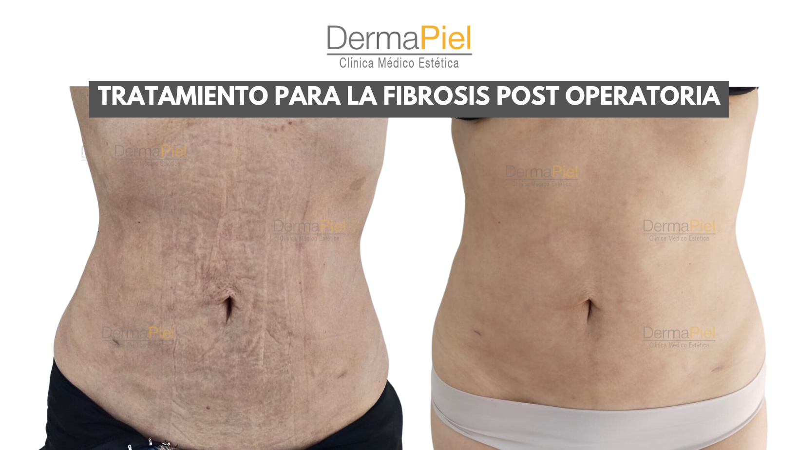HIDROLIPOCLASIA-ULTRASONICA-1.png