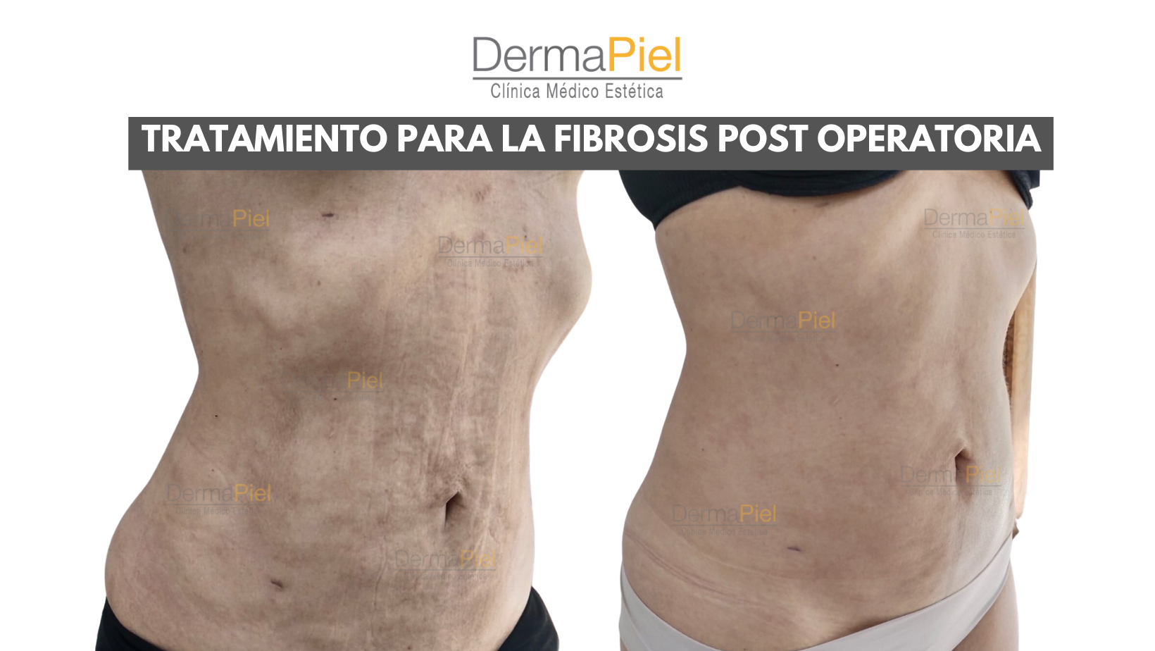 HIDROLIPOCLASIA-ULTRASONICA-2.png