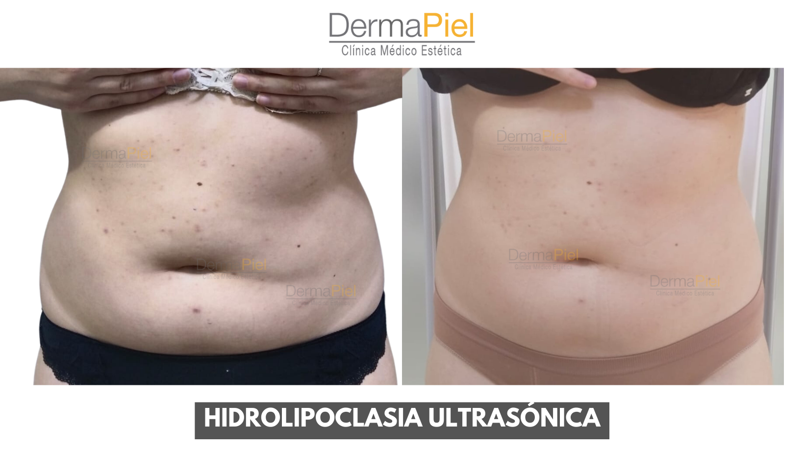 HIDROLIPOCLASIA-ULTRASONICA.png