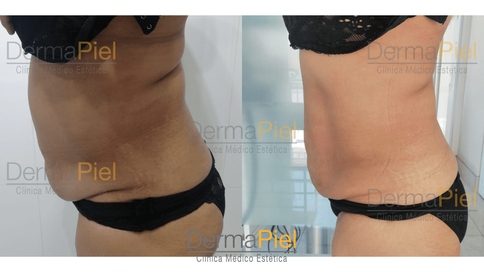 Hidrolipoclasia-antes-y-despues.png