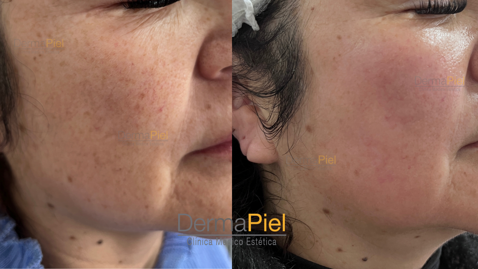 RESULTADOS-CON-1-SESION-DE-PEELING-ORGANICO-4.png