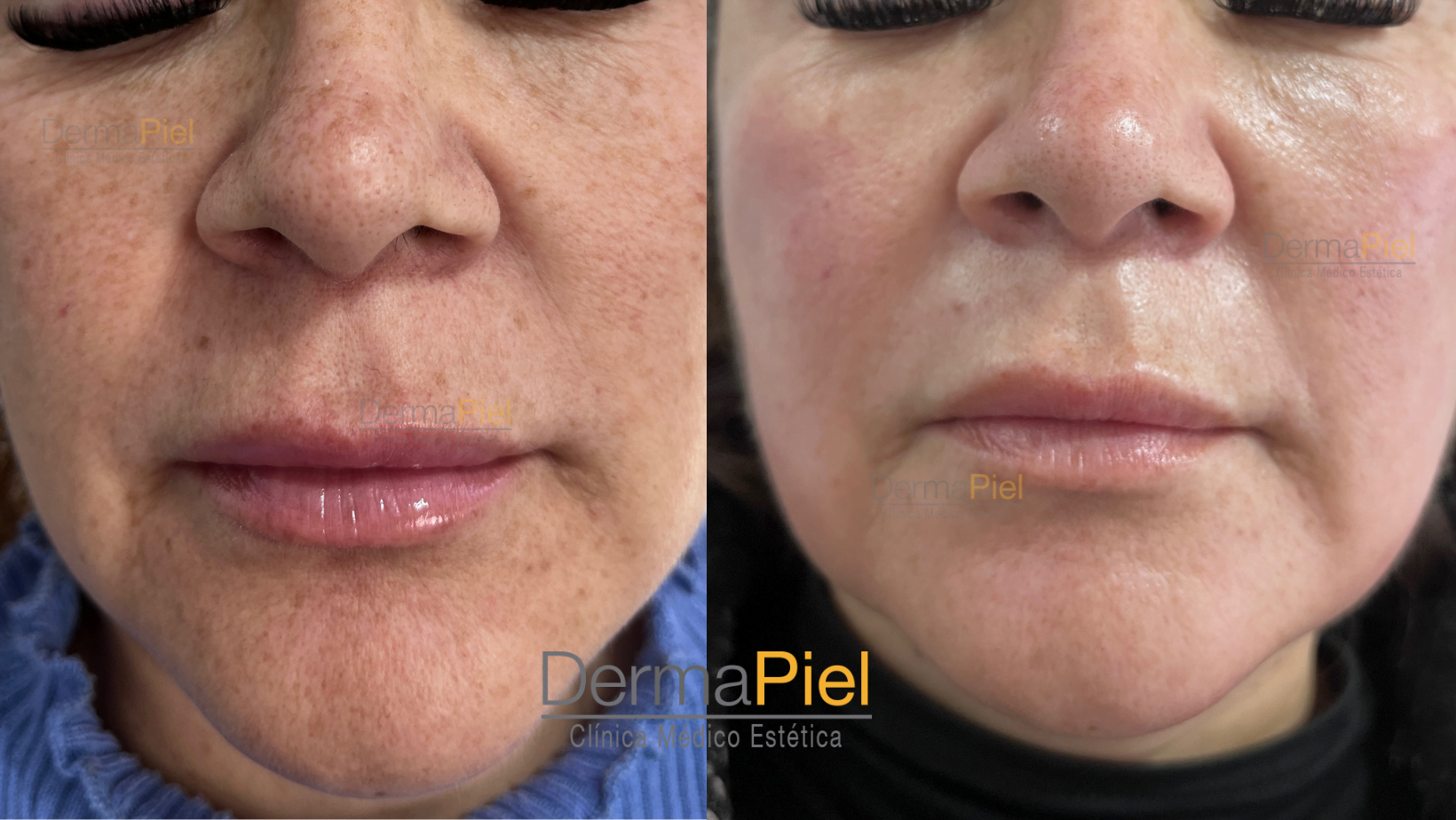 RESULTADOS-CON-1-SESION-DE-PEELING-ORGANICO-5.png