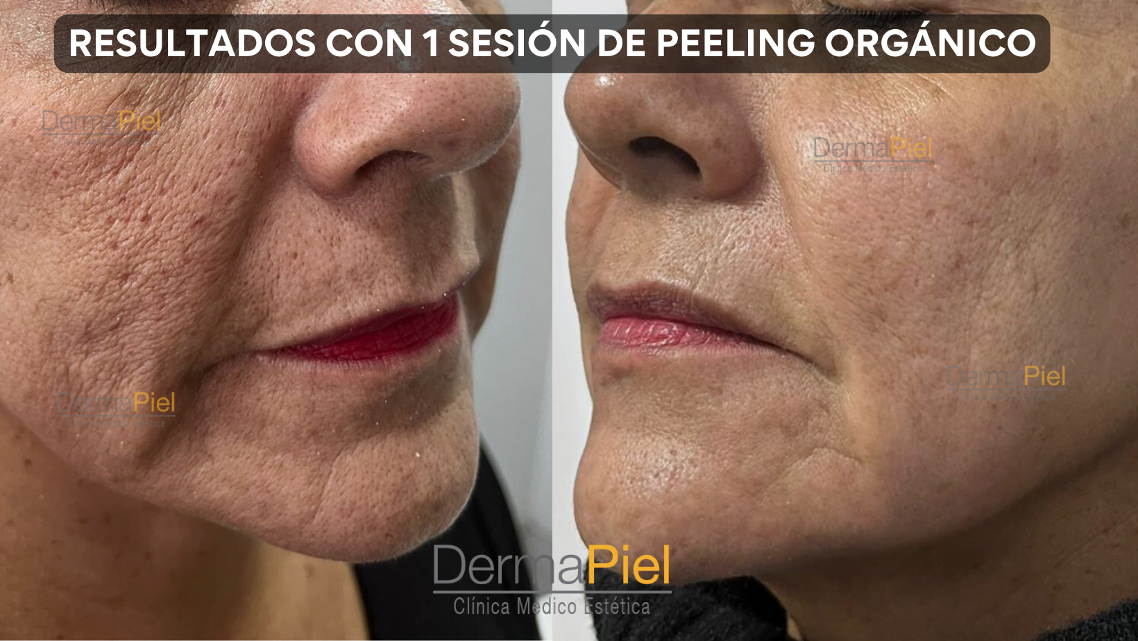 RESULTADOS-CON-1-SESION-DE-PEELING-ORGANICO.png