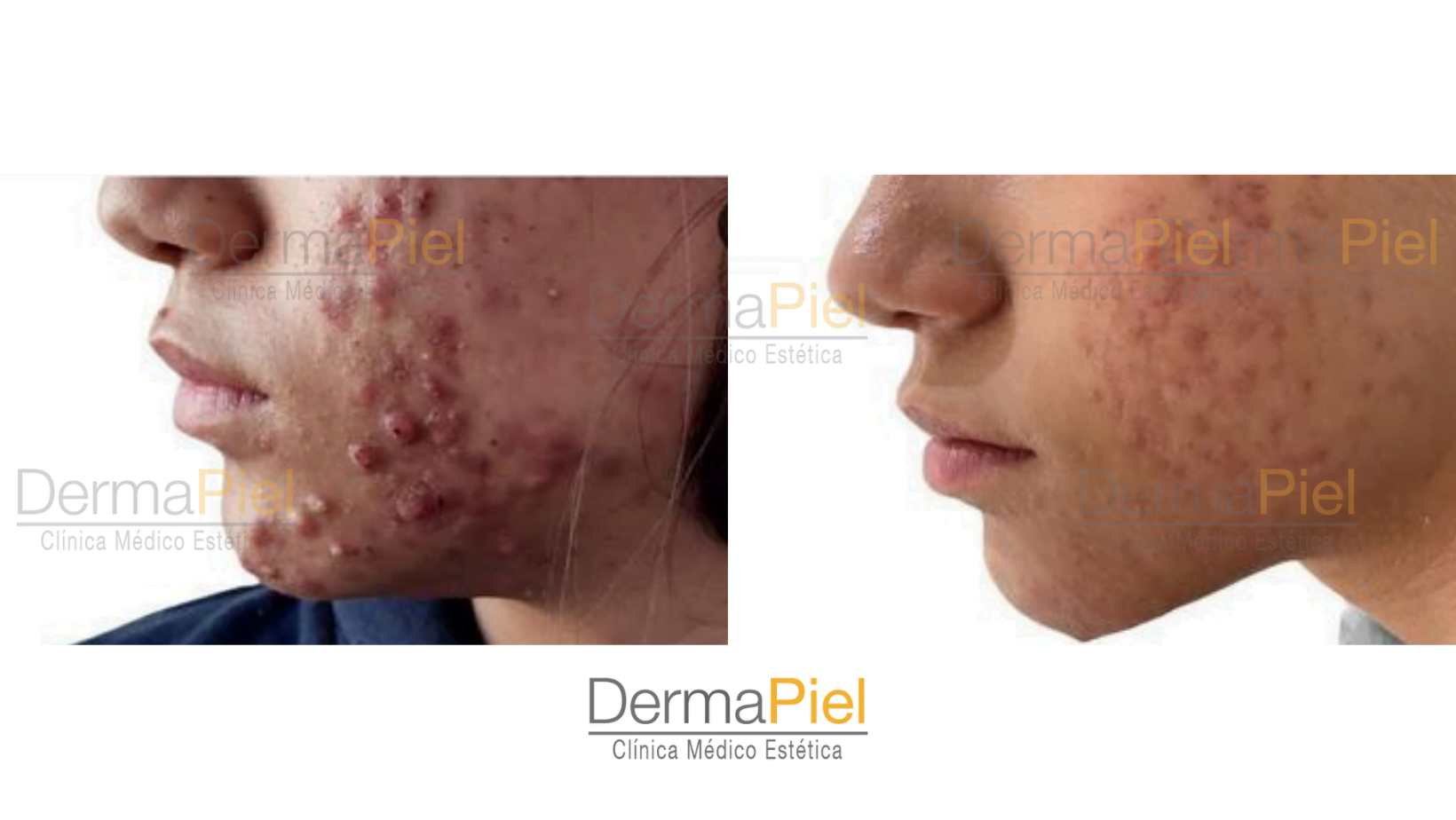antes-y-despues-acne.png