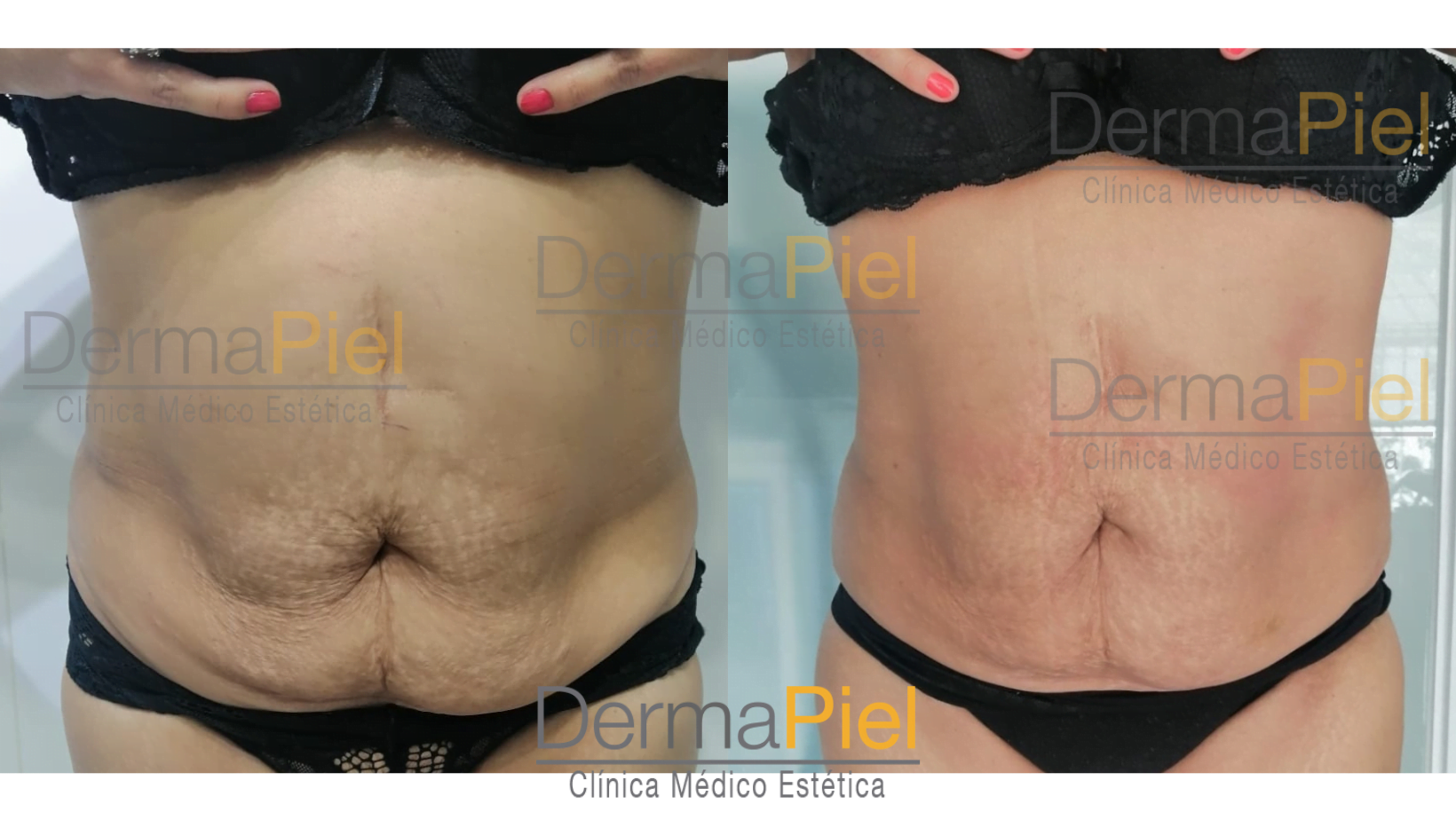 antes-y-despues-hidrolipoclasia.png