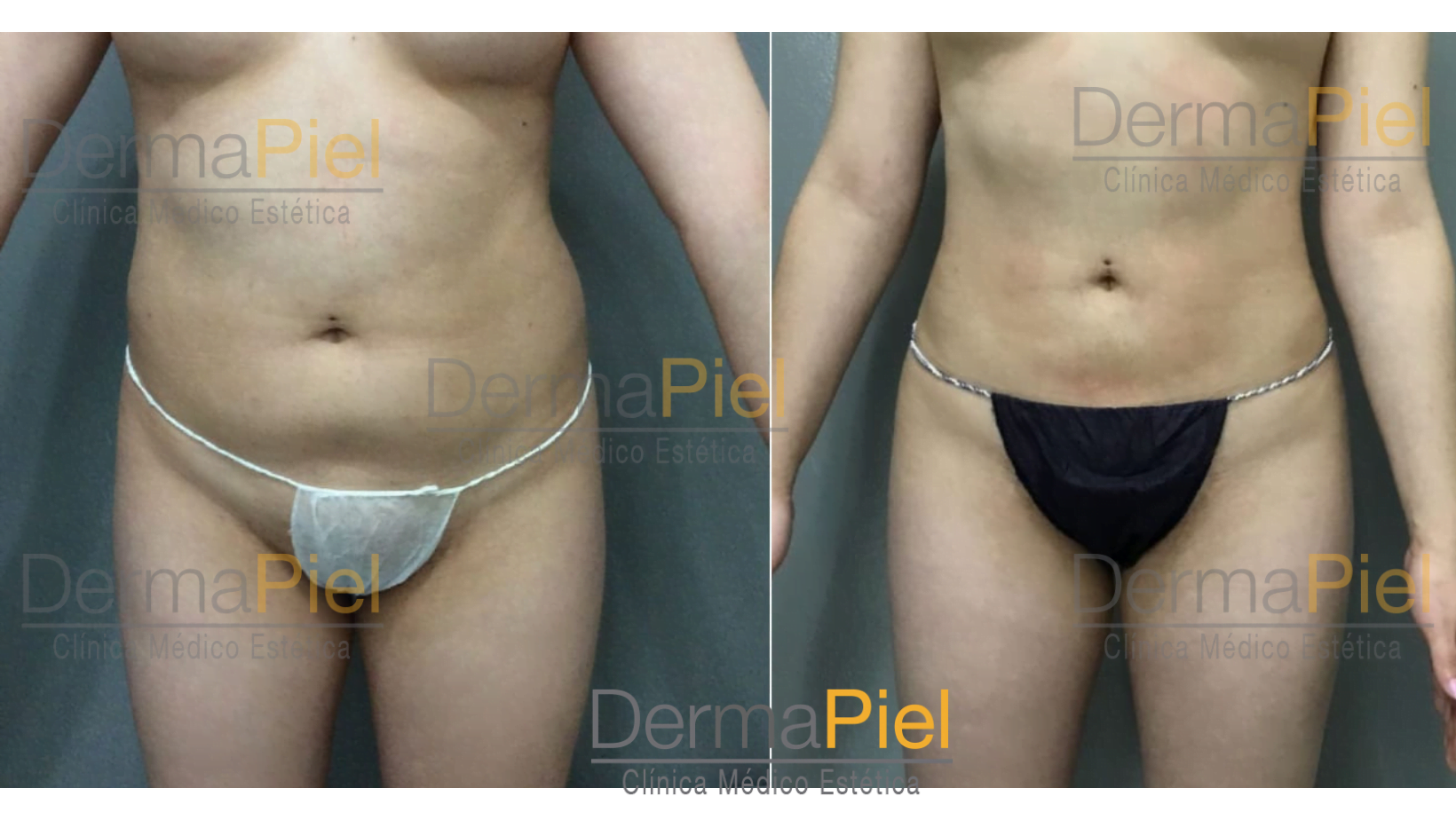 antes-y-despues-liposuccion-anestesia-local.png