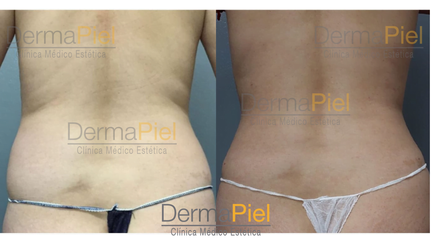 antes-y-despues-liposuccion-dermapiel.png