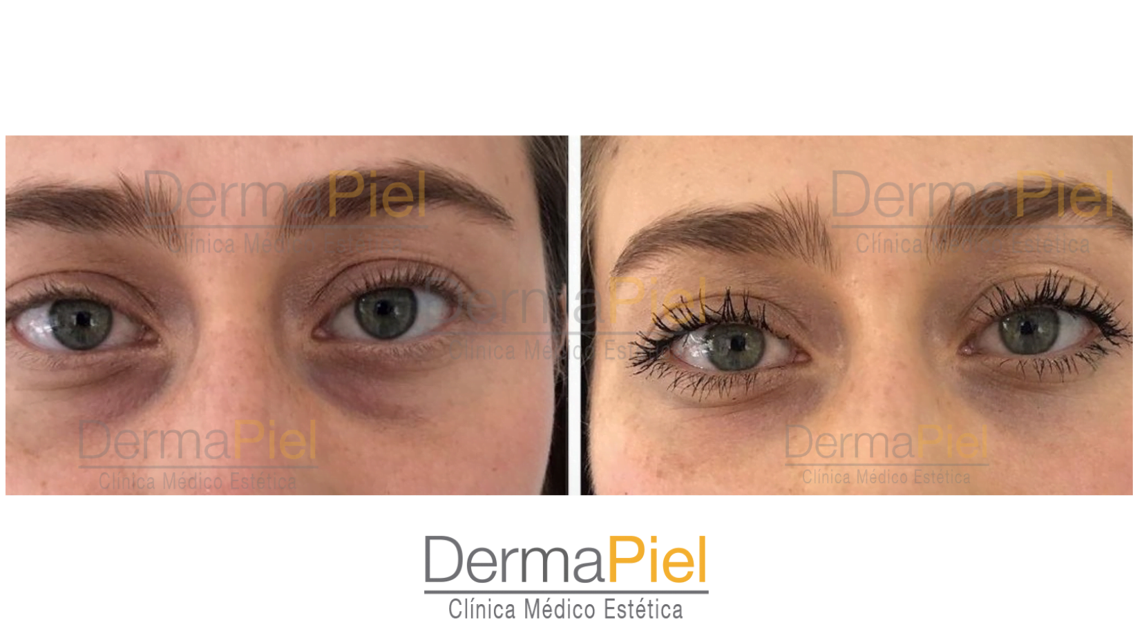 antes-y-despues-relleno-de-ojeras-con-acido-hialuronico-dermapiel-6.png