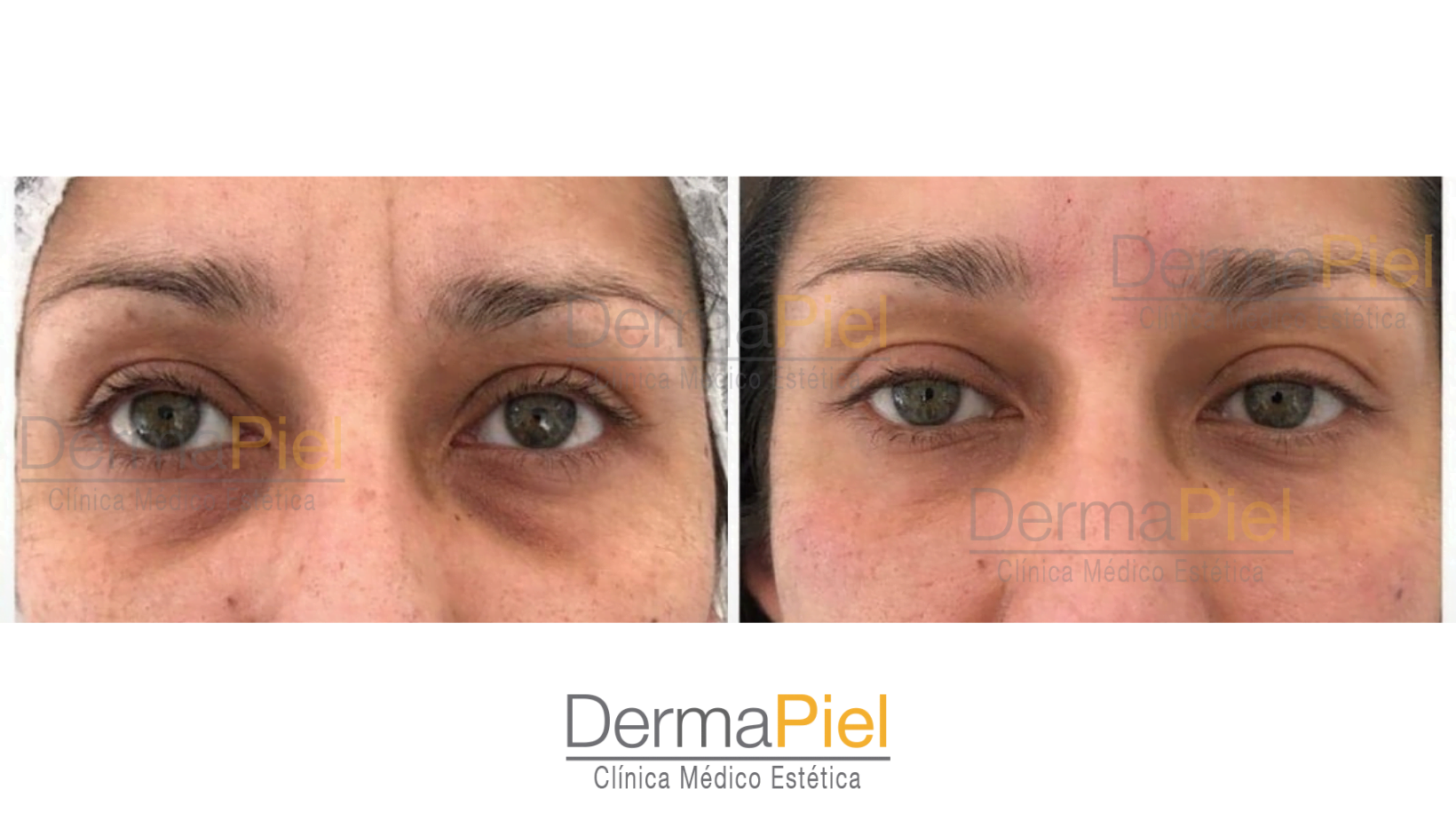 antes-y-despues-relleno-de-ojeras-con-acido-hialuronico-dermapiel-7.png