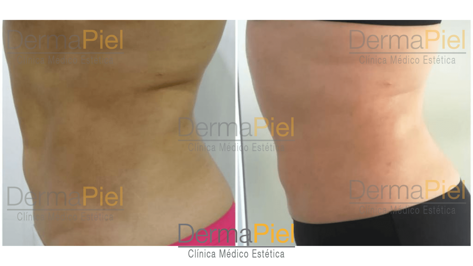 antes-y-despues-tratamiento-reductivo-dermapiel.png