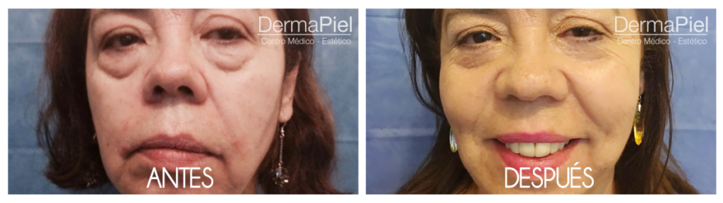 blefaroplastia-1024x288.png