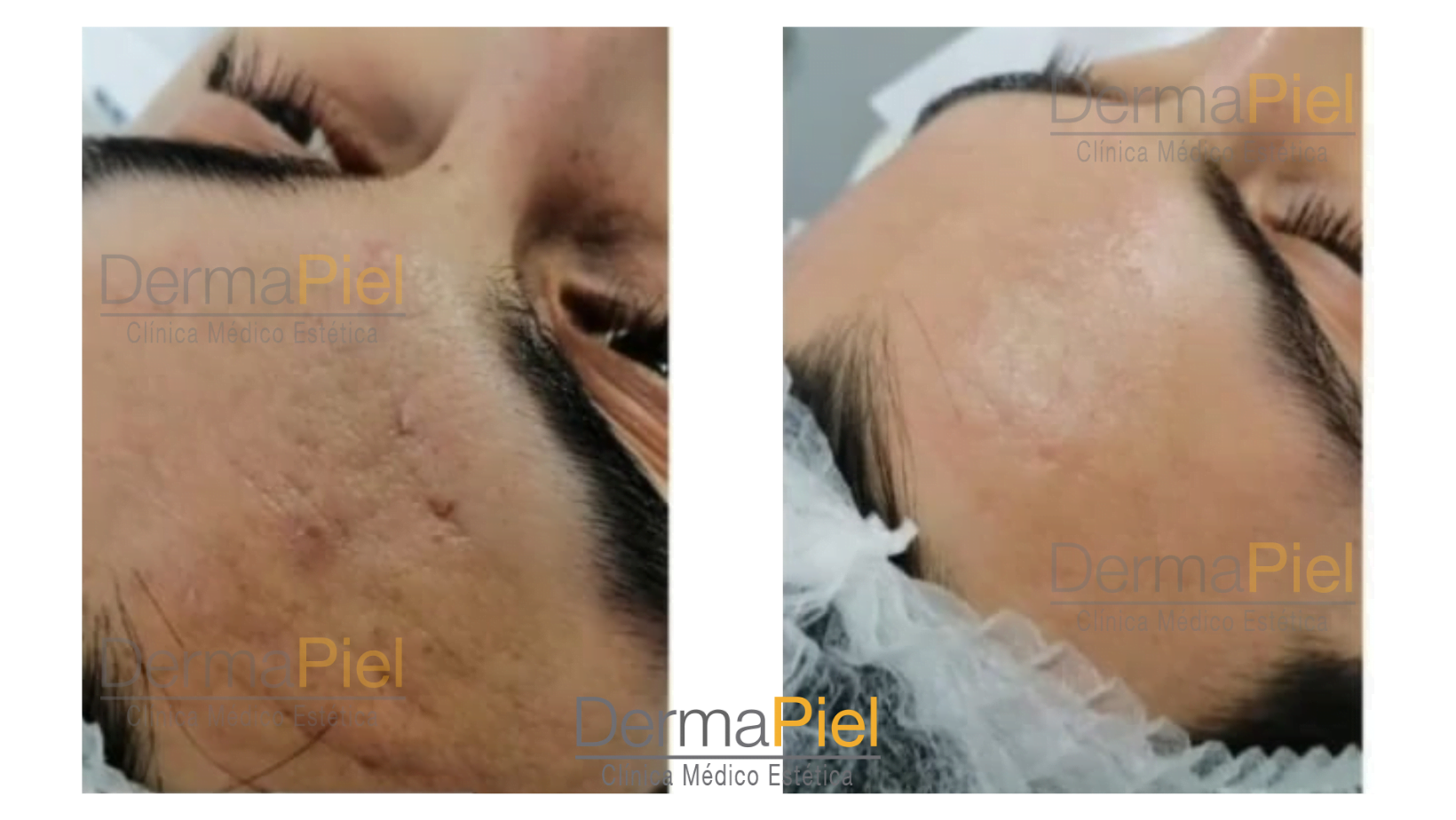 dermapen.png