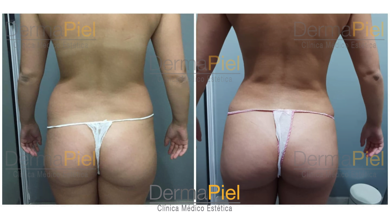 dermapiel-liposuccion.png