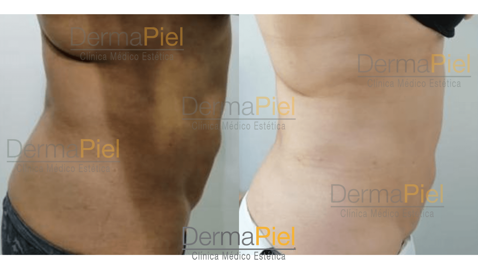 hidrolipoclasia-1-sesion-antes-y-despues.png