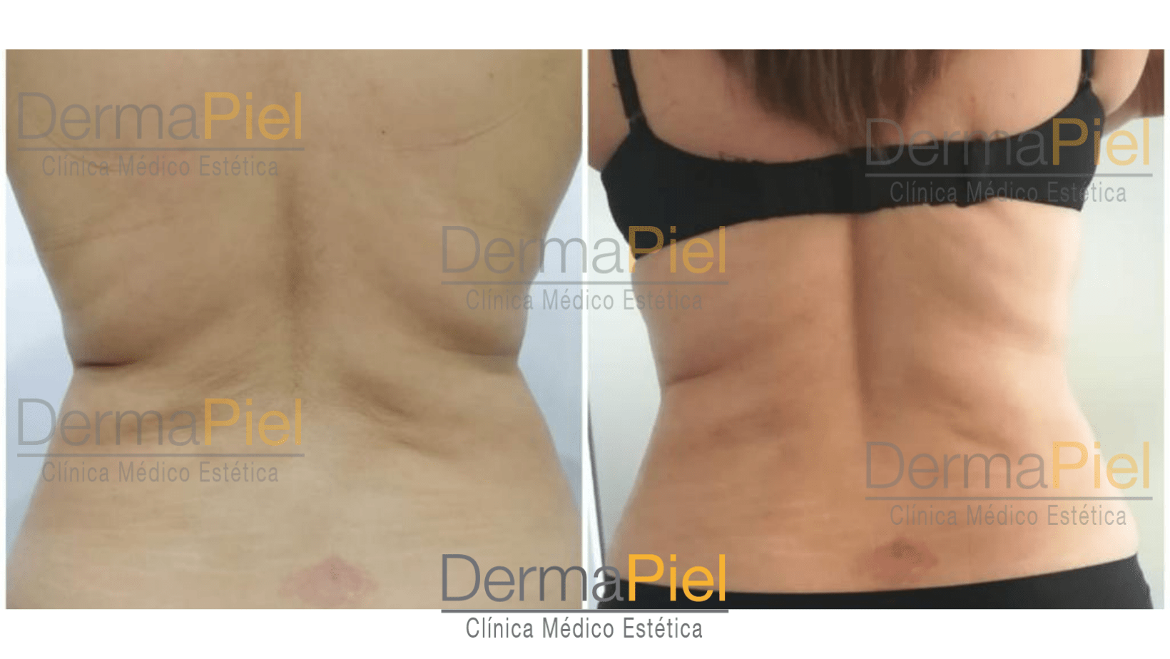 hidrolipoclasia-1-sesion-dermapiel-antes-y-despues.png