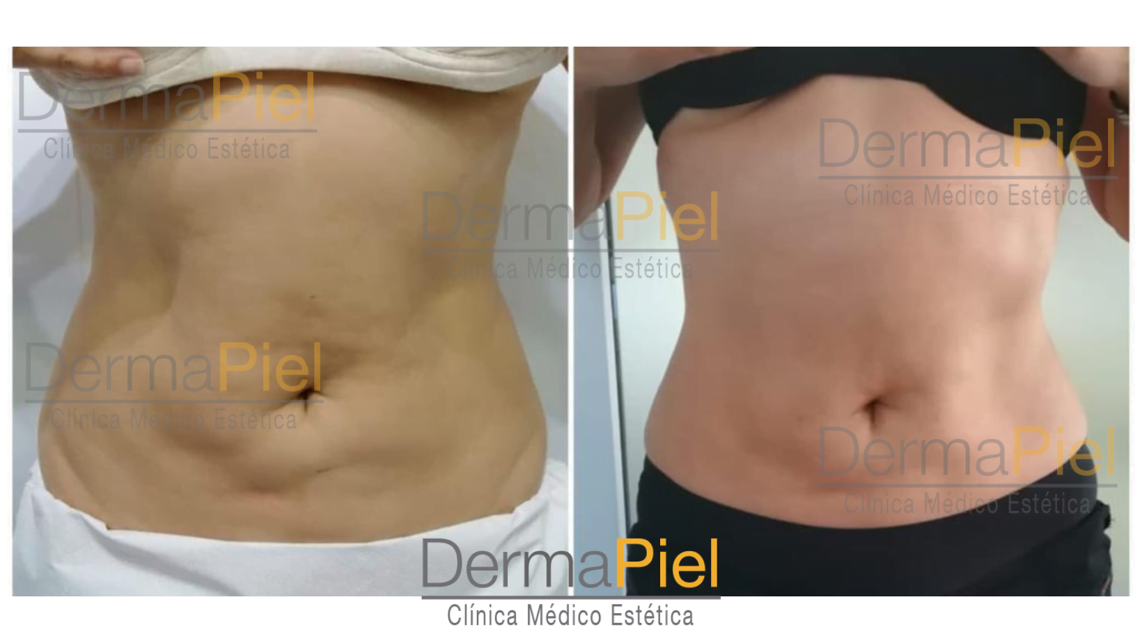 hidrolipoclasia-1-sesion-dermapiel.png