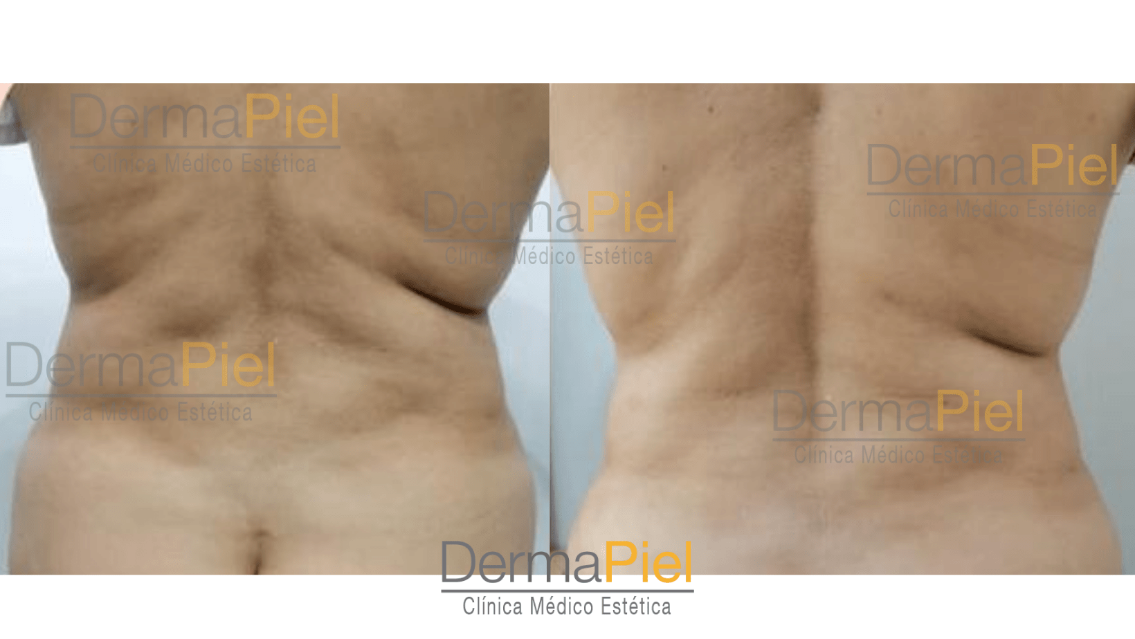 hidrolipoclasia-1.png