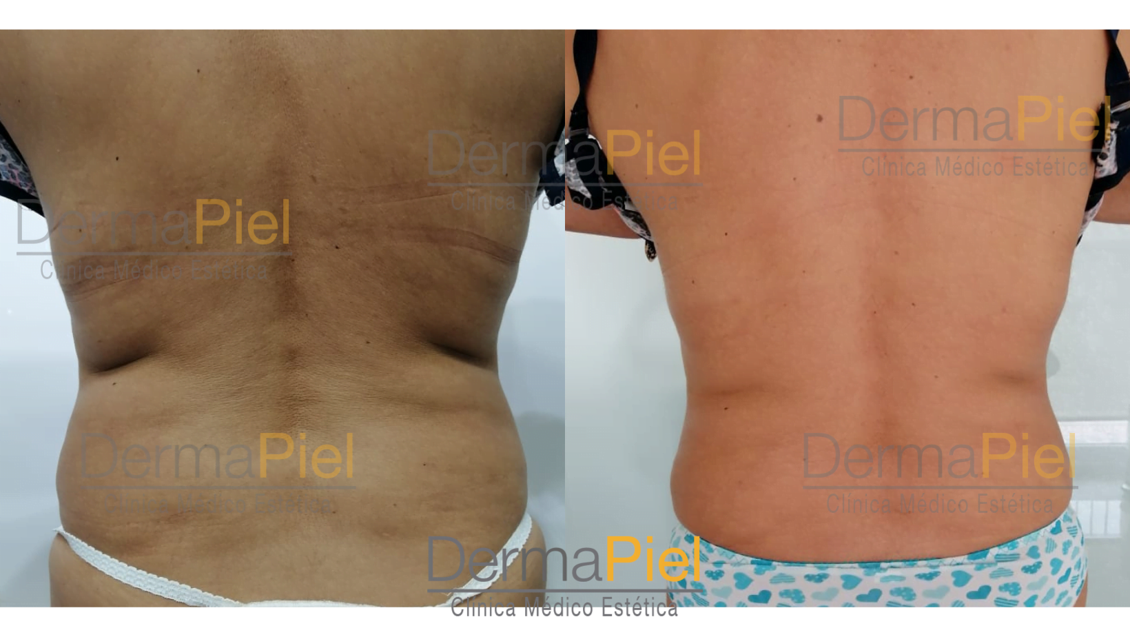 hidrolipoclasia-carboxiterapia.png