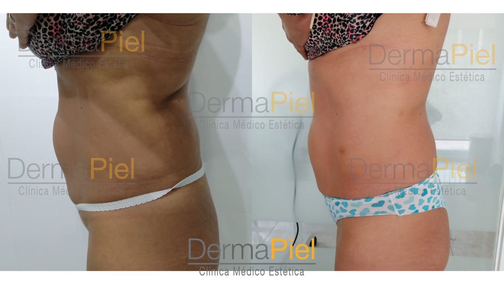 hidrolipoclasia-dermapiel.png