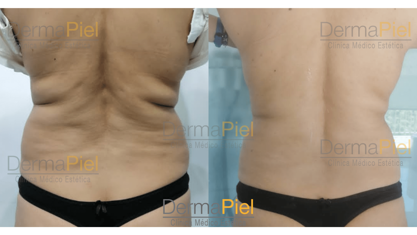 hidrolipoclasia-resultados.png