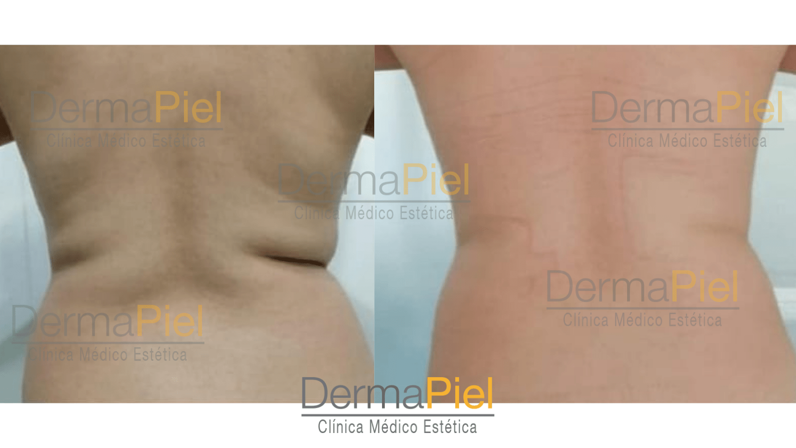 hidrolipoclasia-tratamiento-reductivo.png