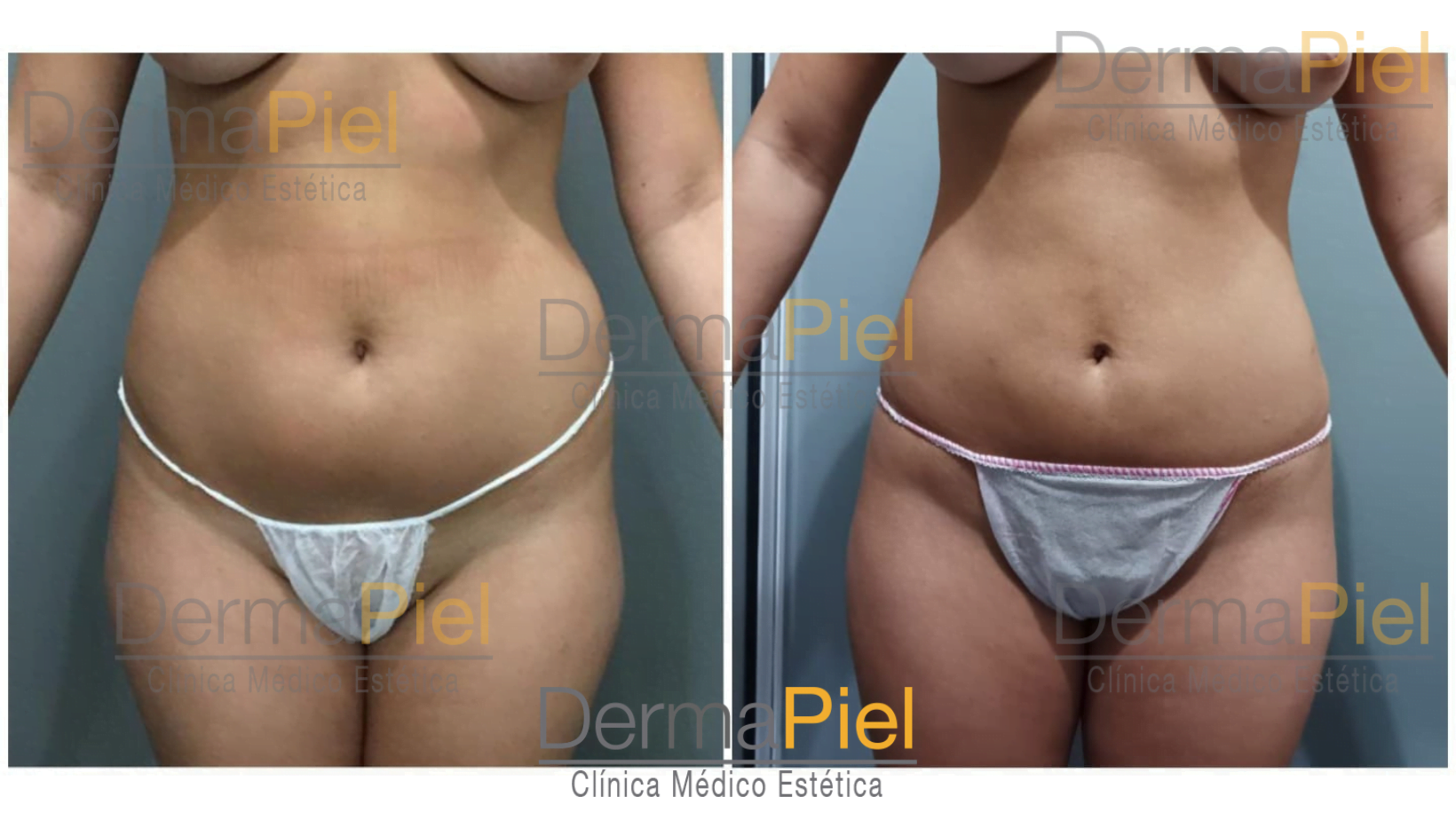 liposuccion-ambulatoria-1-sesion.png