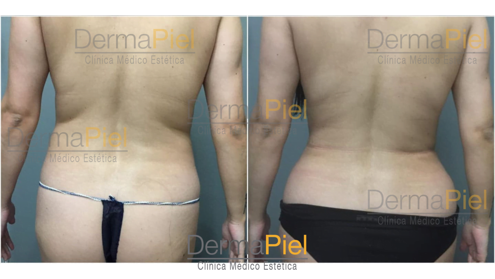 liposuccion-antes-y-despues-2.png