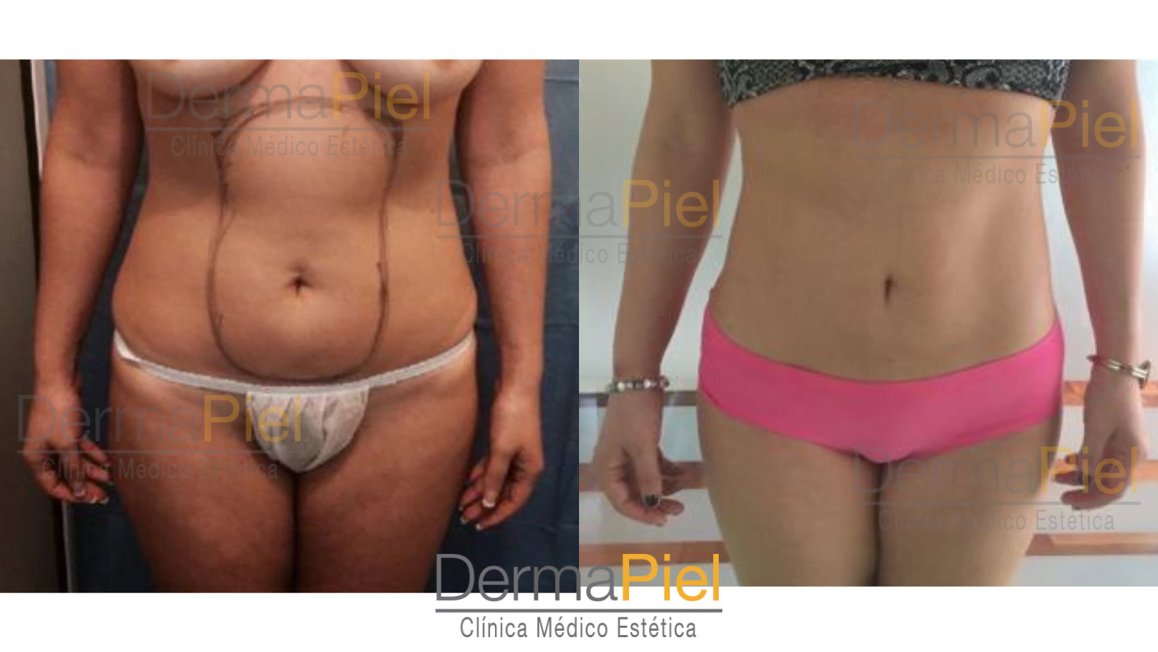 liposuccion-con-anestesia-local-.png
