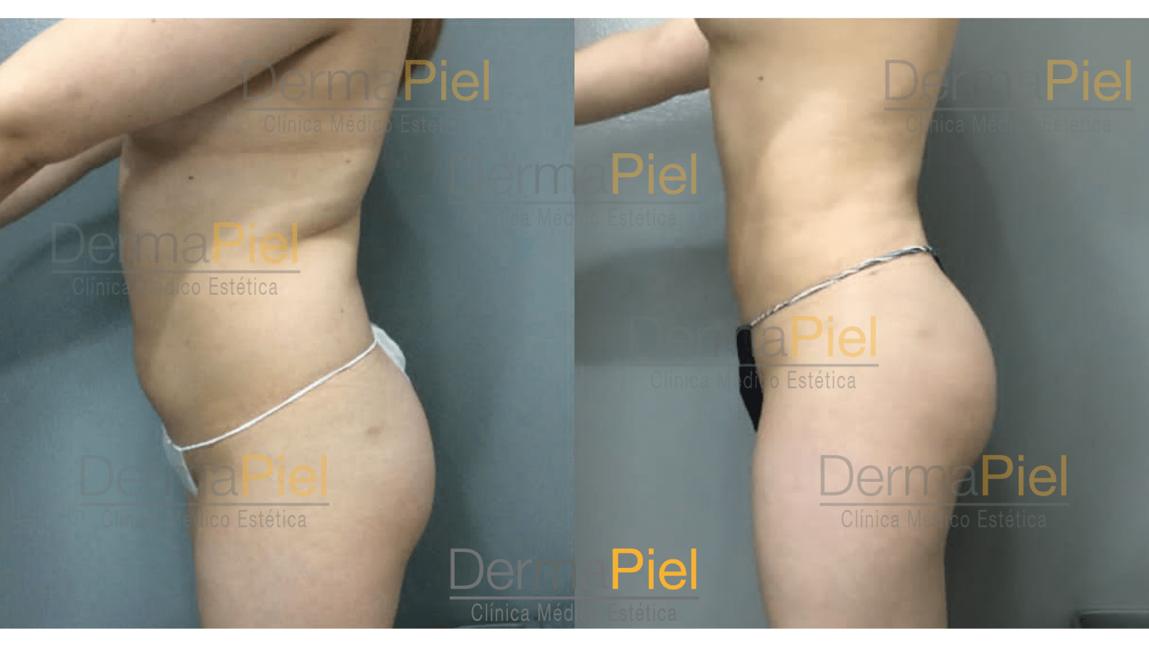 liposuccion-de-lado-.png